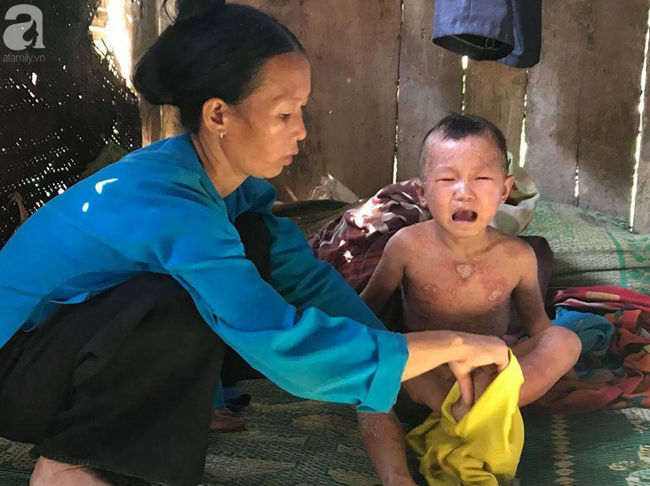 Su thay doi ky dieu cua cau be “nguoi coc” bi benh vay nen-Hinh-2
