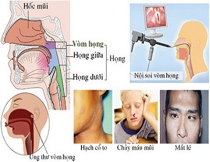 Làm thế nào để phát hiện sớm ung thư vòm họng?