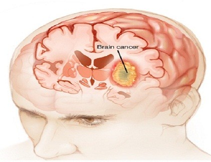 Phân biệt ung thư não với chứng đau đầu thông thường