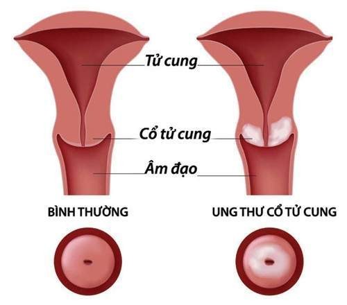 Xét nghiệm ung thư cổ tử cung là một  xét nghiệm quan trọng phụ nữ nên làm ít nhất một lần trong đời. Mặc dù vậy các bác sỹ khuyến cáo nên khám sàng lọc ung thư mỗi ba hoặc năm năm một lần.