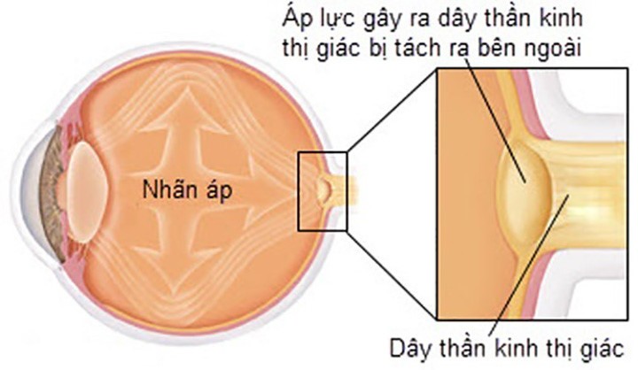  Tăng nhãn áp, hay còn gọi là cườm nước là bệnh lý ở mắt xảy ra khi áp lực thủy dịch trong nhãn cầu tăng cao tạo áp lực lên mắt. Bệnh sẽ làm tổn hại đến các dây thần kinh mắt và gây mù lòa.