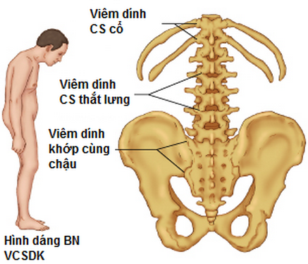 Viêm cột sống dính khớp, lúc nào cần dùng thuốc?