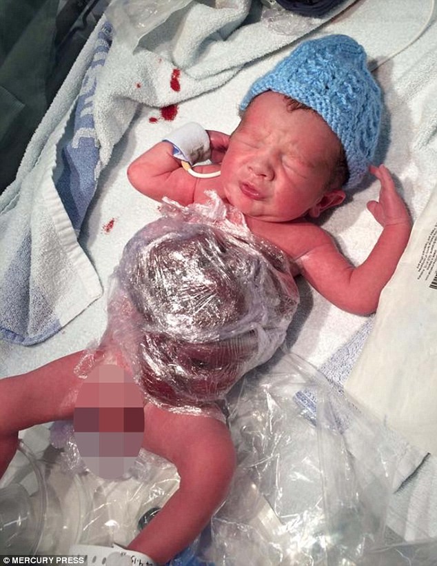 Bé Frankie Banyard mắc một dị tật bẩm sinh có tên gastroschisis, trong đó  ruột ở ngoài cơ thể thông qua khiếm quyết ở một bên của dây rốn. Trong ảnh, các bác sĩ phải dùng màng bọc để quấn dây rốn bên ngoài cơ thể bé.