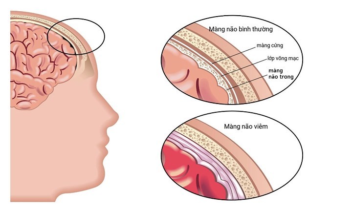 Viêm màng não: Theo MSN, viêm màng não thường do vi khuẩn hoặc virus gây ra, gây nhiễm trùng màng bảo vệ bao quanh não và tủy sống.  Bệnh nguy hiểm xuất hiện nhiều ở trẻ sơ sinh, trẻ nhỏ và thanh thiếu niên.