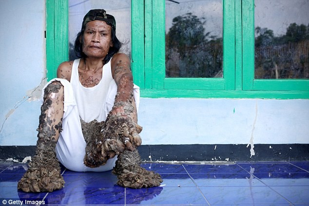 Abul Bajandar, 25 tuổi đến từ Bangladesh đã phải sống chung cùng căn bệnh Epidermodysplasia Verruciformis quái ác, một chứng rối loạn da do di truyền khiến anh được biết đến như “người cây” vì số lượng mụn cóc dày đặc giống các bướu cây sần sùi trên cơ thể.