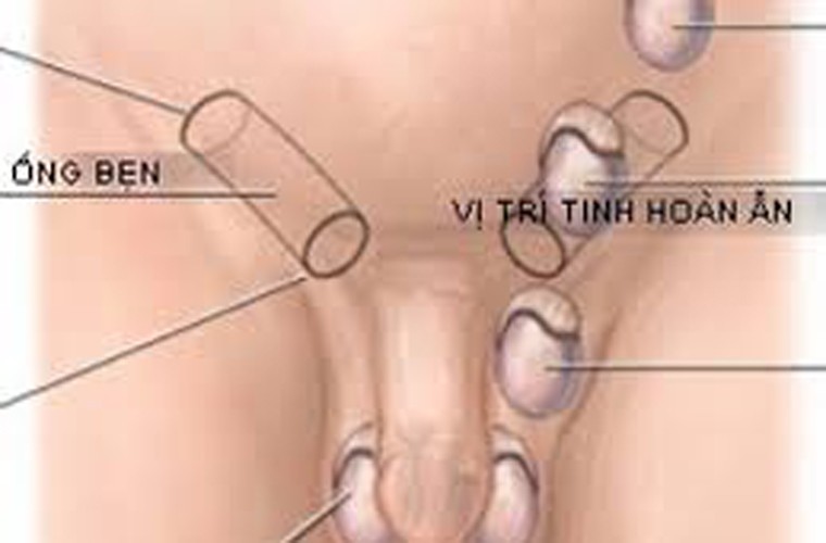 Phẫu thuật tinh hoàn ẩn. Tinh hoàn ẩn là tình trạng bé trai khi sinh ra một hoặc cả hai tinh hoàn không di chuyển xuống bìu mà nằm ở bụng hoặc chỉ xuống một phần.