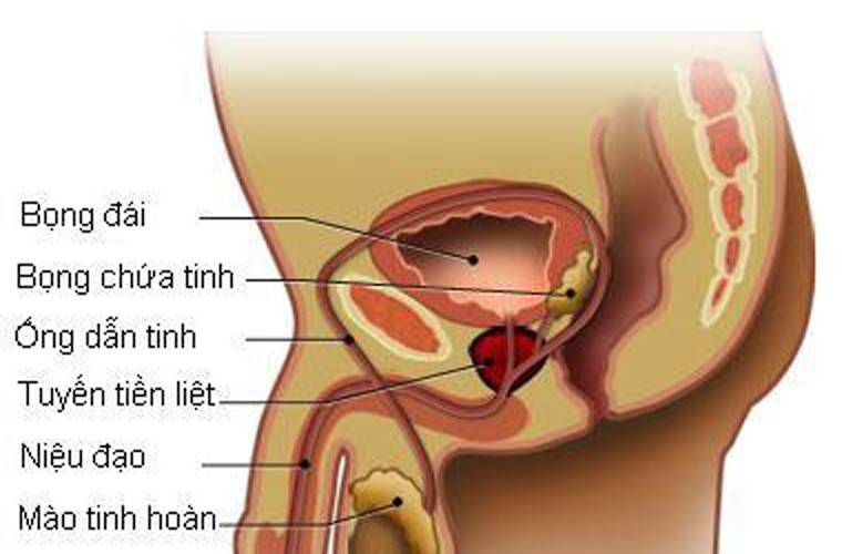 Viêm tiền liệt tuyến là một dạng viêm nhiễm ở tiền liệt tuyến. Ở giai đoạn đầu, người bệnh sẽ có các biểu hiện như đi tiểu nhiều lần, tiểu gấp, tiểu đau kèm theo sốt. số triệu chứng tiêu biểu như đi tiểu nhiều lần, tiểu gấp, tiểu đau, kèm theo sốt....