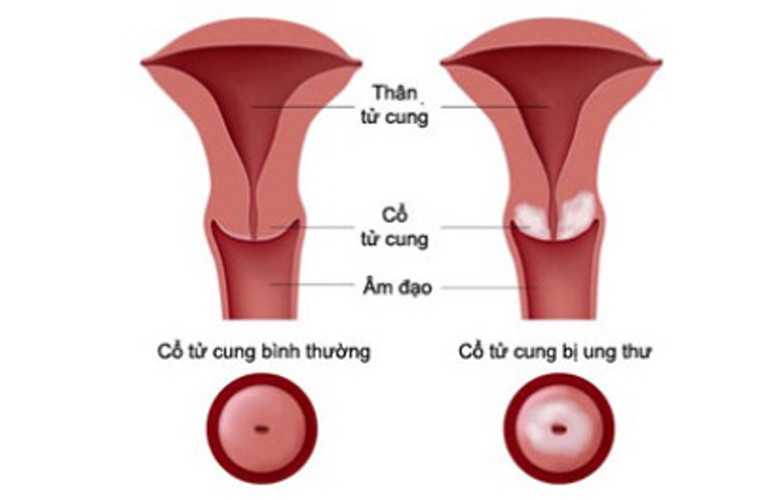 Ngoài việc áp dụng các phương pháp điều trị truyền thống, một số trường hợp, sử dụng các loại thảo dược cũng đem lại hiệu quả bất ngờ. Dù có lợi song bệnh nhân không nên tùy ý quyết định mà phải nghiêm túc thực hiện theo chỉ định của bác sĩ.