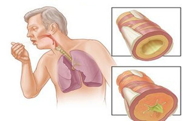 Trái cây và rau quả. Đóng vai trò quan trọng cho một chế độ ăn uống lành mạnh nhất. Nó tăng cường khả năng chống lại bệnh tật và nhiễm trùng của cơ thể. Cần tránh những loại thức ăn đầy hơi, vì nếu một khi bụng bị phình to, có thể hô hấp sẽ trầm trọng hơn. Ảnh. Duocanbinh.