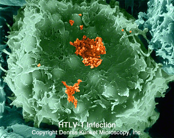  Virus dưỡng Lympo HTLV-1. Virus này có liên quan đến một loại bệnh bạch cầu dòng lympho và u lympho không Hodgkin được gọi là bệnh bạch cầu hay u lympho tế bào T trưởng thành(ATL). Loại ung thư này được tìm thấy chủ yếu ở miền Nam Nhật Bản, Caribbe, Trung Phi, một phần Nam Mỹ, trong một số nhóm người nhập cư ở miền Đông Nam nước Mỹ.