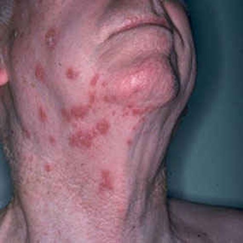 Bệnh zona thần kinh là bệnh nhiễm trùng do virus varicella-zoster gây phát ban khắp cơ thể. Đây cũng là virus gây thủy đậu ở trẻ em. Nó trú ngụ trong cơ thể và kích hoạt phát triển thành bệnh zona.