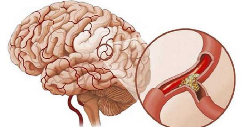 Cao huyết áp là nguyên nhân gây  tai biến mạch máu não hàng đầu. Người bị cao huyết áp có nguy cơ tai biến cao gấp 3 – 4 lần so với người có chỉ số huyết áp bình thường. Ảnh: amazonaws.