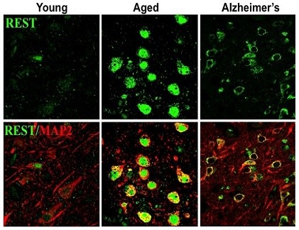 Bảo vệ não ngừa bệnh Alzheimer