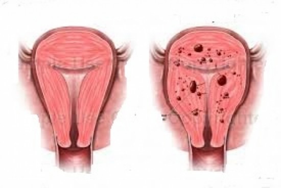  Phân biệt đau bụng kinh và lạc nội mạc tử cung 