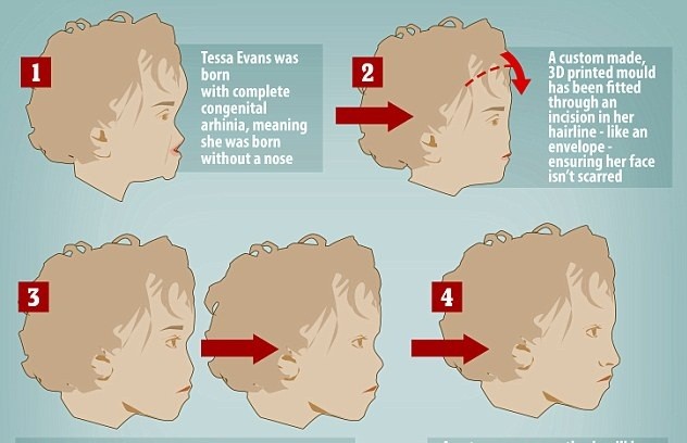 Em bé không mũi được phẫu thuật tạo mũi như thế nào?