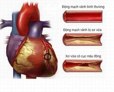 Hệ tim mạch.  Hút thuốc lá gây tổn thương tới toàn bộ hệ tim mạch. Khi nicotin được hít vào cơ thể, nó khiến cho mạch máu bị co lại, cản trở lưu thông máu. Hút thuốc làm giảm hàm lượng cholesterol tốt và tăng huyết áp, có thể dẫn tới giãn động mạch và tích tụ cholesterol xấu. Hút thuốc cũng làm tăng nguy cơ hình thành cục máu đông từ đó tăng nguy cơ bệnh tim và đột quỵ. Về lâu dài, những người hút thuốc có nguy cơ cao hơn bị ung thư máu. Ảnh: http://huyetap.net/