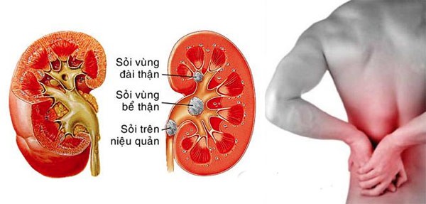 Bác sĩ thường khuyên bệnh nhân sỏi thận nên hạn chế các thực phẩm có axit oxalic vì nó ảnh hưởng nhiều trên sự ức chế hấp thu canxi và kẽm, dễ hình thành các sỏi oxalate. Hàm lượng acid uric trong cơ thể cao sẽ làm tăng nguy cơ bị sỏi thận và làm tăng nồng độ canxi oxalate trong nước tiểu, dẫn đến sỏi thận ngày càng to và trầm trọng.