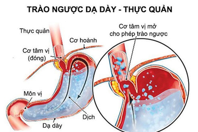 Người bị bệnh trào ngược dạ dày: Chất béo trong sữa sẽ ảnh hưởng đến sự co bóp cơ vòng thực quản dưới, từ đó làm tăng sự trào ngược của dịch dạ dày hoặc dịch ruột, khiến tình trạng bệnh trào ngược dạ dày thực quản thêm nghiêm trọng.