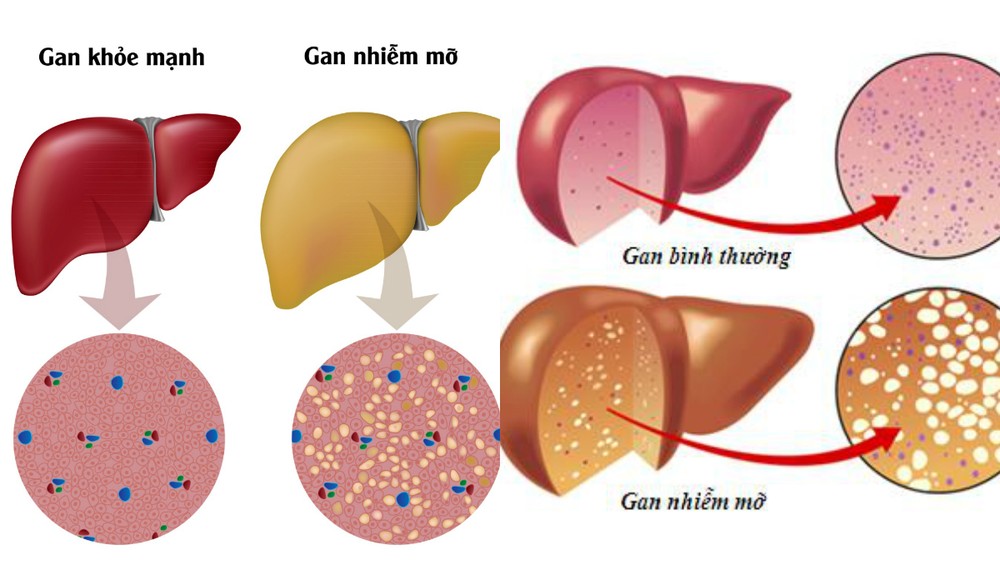 Lá gan của người Việt “khổ” như thế nào?