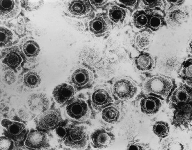 Nhiễm virus: Hội chứng mệt mỏi mãn tính sau khi bị nhiễm virus, bao gồm Epstein-Barr, herpesvirus...