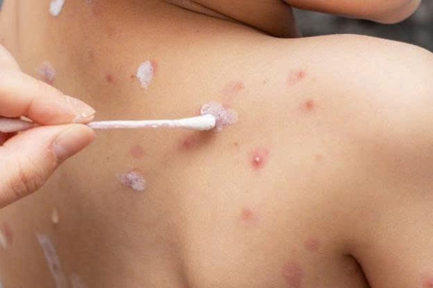Khi bị thủy đậu, việc kiêng ăn một số loại thực phẩm có thể giúp người bệnh hồi phục nhanh hơn và tránh tình trạng sẹo. Dưới đây là danh sách các loại thực phẩm cần tránh trong quá trình trị bệnh thủy đậu. Ảnh VNC
