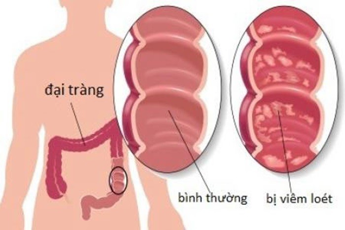 Viêm đại tràng là bệnh khá phổ biến hiện nay. Viêm đại tràng nếu để lâu có thể gây ra những biến chứng nguy hiểm như đại tràng cấp tính, thủng đại tràng, chảy máu nặng và có thể dẫn đến ung thư trực tràng. Vì thế, khi còn nhẹ, bạn hãy dùng các bài thuốc dân gian chữa viêm đại tràng để dứt hẳn bệnh này. Ảnh: SKĐS.