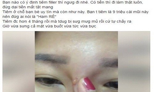 Hotgirl bị chảy dịch mủ sau tiêm filler nâng mũi 