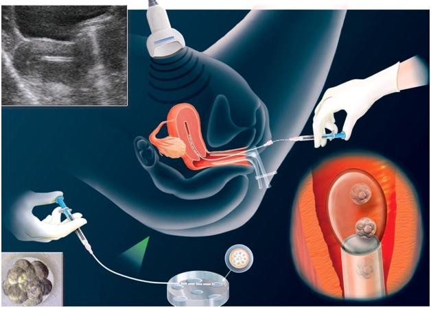 Chuyển phôi là công đoạn quan trọng trong quá trình thực hiện thụ tinh nhân tạo hoặc trợ giúp những phụ nữ khó có thể có thai tự nhiên có thể mang thai và sinh con.