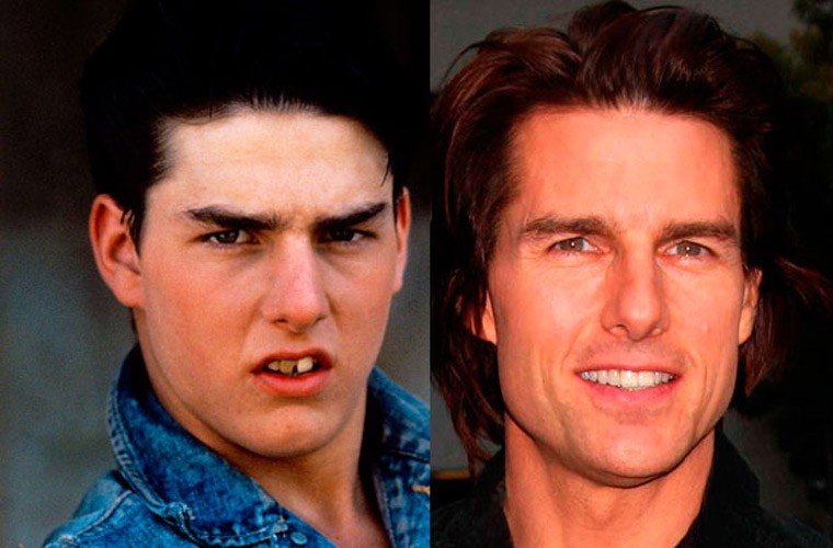 Hàm răng thời chưa nổi tiếng của Tom Cruise vừa nhấp nhô vừa ố vàng chứ không đều tăm tắp và trắng bong như bây giờ. Thế nên nhìn Tom hồi trẻ, chẳng ai khen anh đẹp trai.