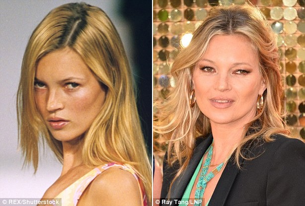 Siêu mẫu Kate Moss được cho là đã bơm chất làm đầy vào phía dưới mắt để đôi mắt không bị nhăn nhúm, già nua và nhờ thế mà cô giữ được vẻ trẻ trung suốt bao năm qua.