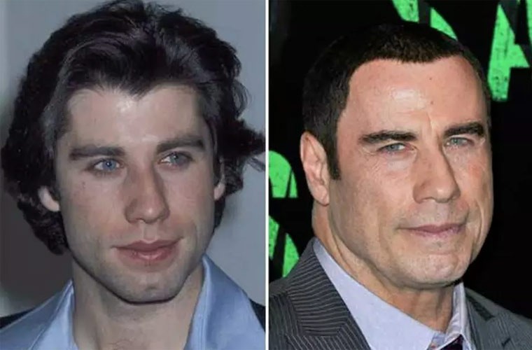 Sau nhiều lần phẫu thuật thẩm mỹ thì John Travolta hiện tại đã không còn là John của ngày xưa nữa. Nếu so sánh ảnh xưa và nay thì thấy rõ ràng nhất là ngôi sao Pulp Fiction cấy tóc. (Ảnh: VIP Plastic Surgery)