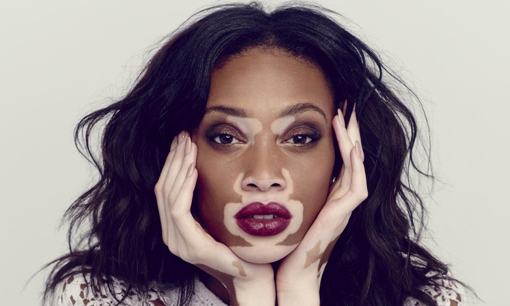 Winnie Harlow là cái tên quen thuộc của làng thời trang thế giới. Giữa vô số  người mẫu sở hữu vẻ đẹp chuẩn mực, cô gái 24 tuổi trở thành hiện tượng lạ bởi làn da bạch biến, loang lổ khắp cơ thể. Điều này khiến cô bị người khác gọi là bò, ngựa vằn và nhiều lần có ý định tự sát. Sau khi vượt qua mặc cảm, cô quyết tâm chứng minh giá trị bản thân bằng cách tham gia America's Next Top Model 2014, để lại ấn tượng với khán giả bằng kỹ năng người mẫu chuyên nghiệp.