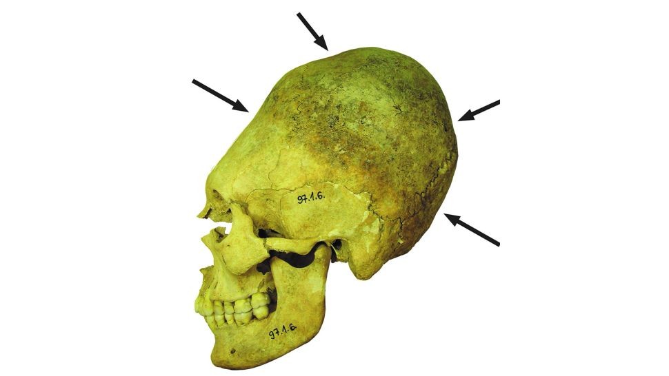Trong các cuộc khai quật tại một nghĩa trang ở Mözs-Icsei dulo, Hungary, các nhà khảo cổ tìm thấy hàng chục  hộp sọ ''ngoài hành tinh'' có niên đại hơn 1.000 năm tuổi.