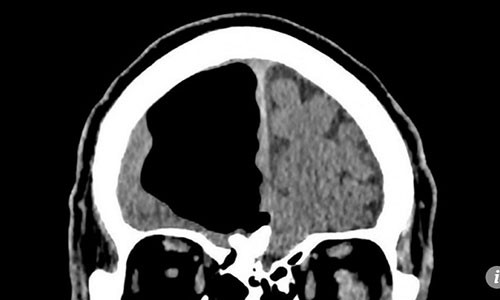Nhập viện vì đau đầu, choáng váng thấy điều này trong não
