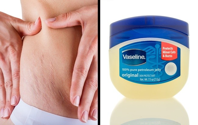 Vaseline là  cách xóa sẹo hiệu quả và tiết kiệm. Thoa kem 3 lần/ngày trong vòng từ 1-3 tuần, sẽ giúp giữ ẩm cho làn da của bạn, phần da bị sẹo bớt khô và xù xì hơn.