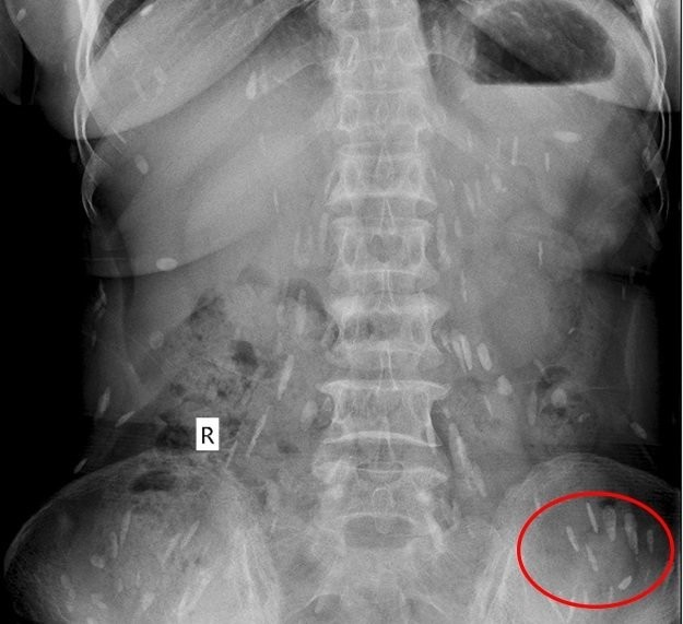 Ngày 22/3, Bệnh viện Hoàn Mỹ Quốc tế Vinh, Nghệ An, cho biết vừa cấp cứu thành công cho một bệnh nhân bị rất nhiều  sán ký sinh trong cơ thể. Bệnh nhân là P.T.Đ (55 tuổi) tới Bệnh viện khám trong tình trạng mệt mỏi, đầy bụng, đau đầu và đau ở vùng ngực, thắt lưng nhiều…Ảnh: GĐVN.