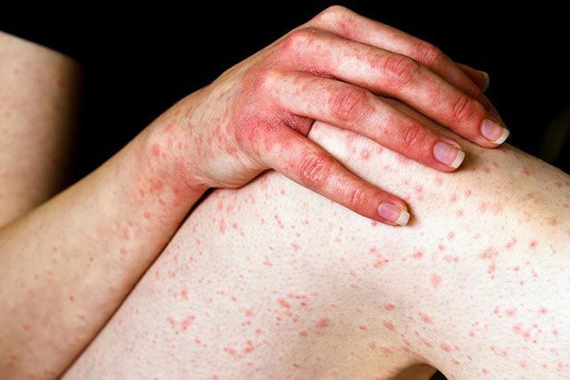 Histamine: Mặc dù là một chất dẫn truyền thần kinh thiết yếu trong cơ thể con người nhưng histamine lại gây ra phản ứng  dị ứng. Một khi ăn quá nhiều các loại thực phẩm chứa histamine này sẽ khiến cho hệ hô hấp trở nên tồi tệ hơn.