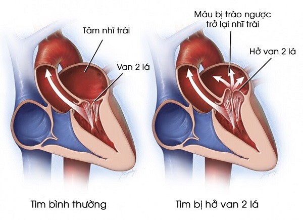 Bệnh hở van tim của Tuấn Hưng nguy hiểm ra sao?