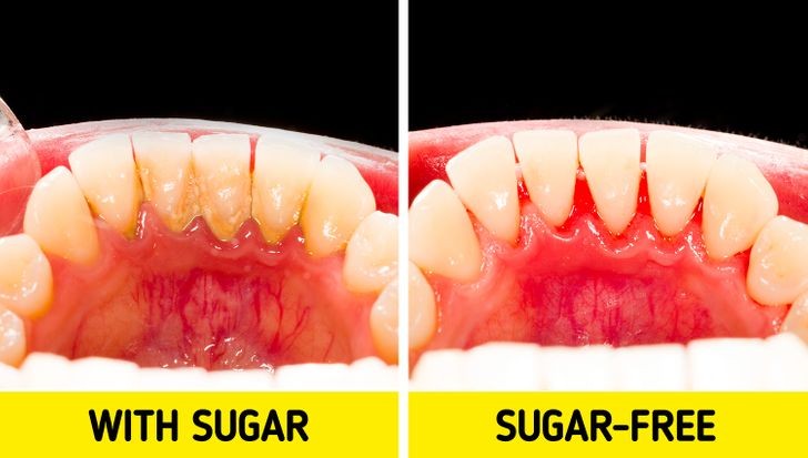 1. Nó ảnh hưởng đến răng của bạn: Kẹo cao su không đường là một chất diệt vi khuẩn hiệu quả, bảo vệ răng của bạn khỏi sâu và viêm lợi. Tuy nhiên, nếu bạn  nhai kẹo cao su chứa đường thì nó lại có tác động tiêu cực đến sức khỏe răng miệng. Vi khuẩn sống trong khoang miệng của bạn, tiêu hóa đường trước khi nó đến dạ dày của bạn, dẫn đến tích tụ mảng bám trên răng. Nó cũng làm tăng sâu răng theo thời gian.