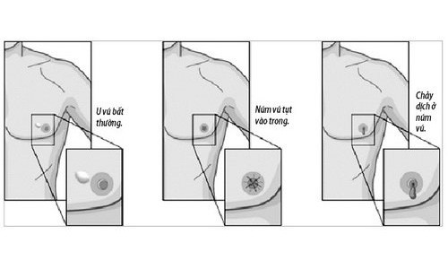 Các dấu hiệu báo động ung thư vú ở nam giới