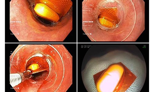 Dở khóc dở cười những ca hóc dị vật ở người lớn