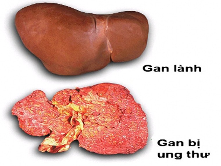 Chuyên gia dinh dưỡng Russell Mark Reisner đến từ Trung tâm điều trị Ung thư Mỹ khẳng định, một trong những vũ khí giúp người bệnh chiến đấu với căn bệnh này chính là chế độ dinh dưỡng.