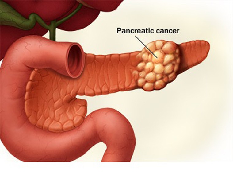 Ung thư tuyến tụy bắt đầu trong các mô của tuyến tụy - một cơ quan ở bụng nằm theo chiều ngang phía sau phần dưới của dạ dày. Bệnh có khả năng di căn mạnh, hiếm khi được phát hiện sớm và có tỷ lệ sống sót sau năm năm rất thấp.