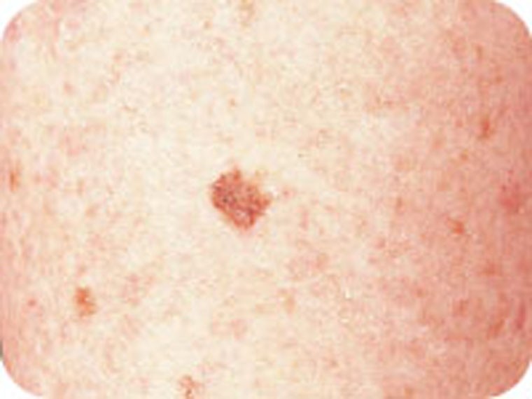  Ung thư da melanoma. Đây được xem là dạng  ung thư da ác tính nguy hiểm nhất. Nếu không được điều trị kịp thời, tế bào ung thư dễ dàng di căn tới bộ phận khác trong cơ thể.    