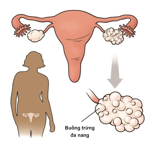 Phụ nữ mắc hội chứng buồng trứng đa nang (PCOS) bắt nguồn từ việc mất cân bằng mức độ insulin trong máu. Các triệu chứng thường gặp khi mắc đa nang như tăng cân nhiều, lông mọc nhiều ở tay, chân, mặt, chu kỳ kinh nguyệt không đều, mụn trứng cá, thậm chí dẫn đến vô sinh.