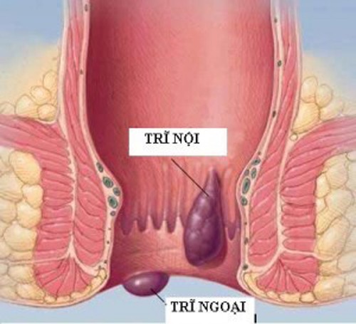 Trĩ là bệnh khá phổ biến, bắt nguồn từ chế độ ăn uống không hợp lý, mất nước, căng thẳng, lười vận động…