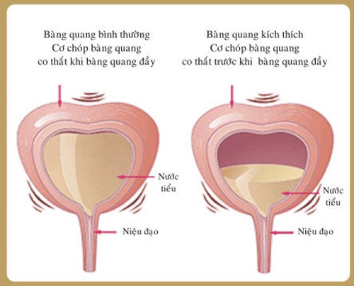 Khi bàng quang chịu áp lực lớn, cơ thể xuất hiện nhu cầu loại bỏ lượng nước thải dư thừa. Chính vì vậy, cơ thể sẽ nhu cầu đào thải lượng nước trên để được “nhẹ nhõm” hơn.