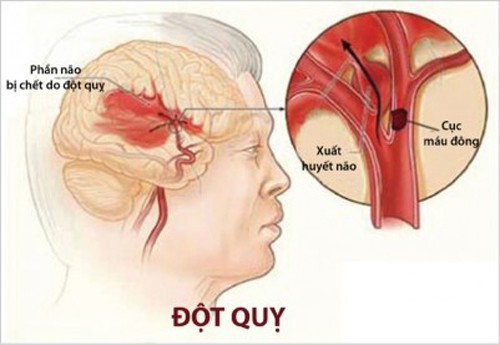 Đột quỵ xảy ra khi lượng máu cung cấp cho một phần của não bộ đột nhiên bị chặn lại hoặc khi có một mạch máu trong não bộ bị vỡ khiến máu tràn vào những khoảng không xung quanh các tế bào não.