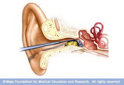 Ráy tai là chất bôi trơn dạng gel được tạo thành từ những tế bào chết tích lũy trong tai. Nó có tác dụng bảo vệ tai song việc tích tụ quá nhiều có thể dẫn tới giảm thính giác tạm thời, đau tai, ngứa, chóng mặt, nhiễm trùng…