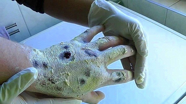 Krokodil là một loại ma túy tự chế đang được rất nhiều con nghiện ở Nga sử dụng, loại ma tuý này mạnh gấp 10 lần heroin. Sức tàn phá của nó cũng rất khủng khiếp, khi sử dụng ngoài da trở nên tím tái, xếp vảy như da cá sấu rồi hoại tử dần đến khi lộ cả xương. Loại ma tuý này tàn phá cơ thể chỉ trong vòng 1 đến 2 năm là người sử dụng sẽ tử vong.